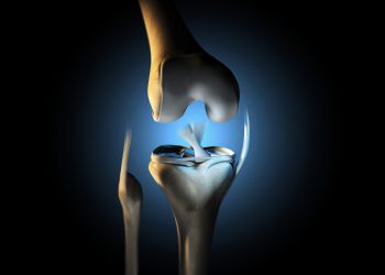 The Importance of Electropolishing in the Orthopedic Industry